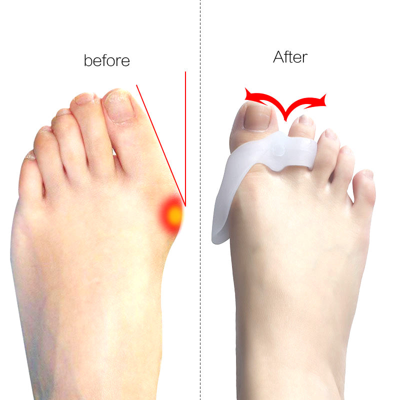 SILICONE BUNION CORRECTOR
